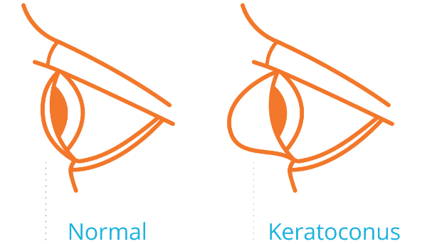 Keratoconus Illustration