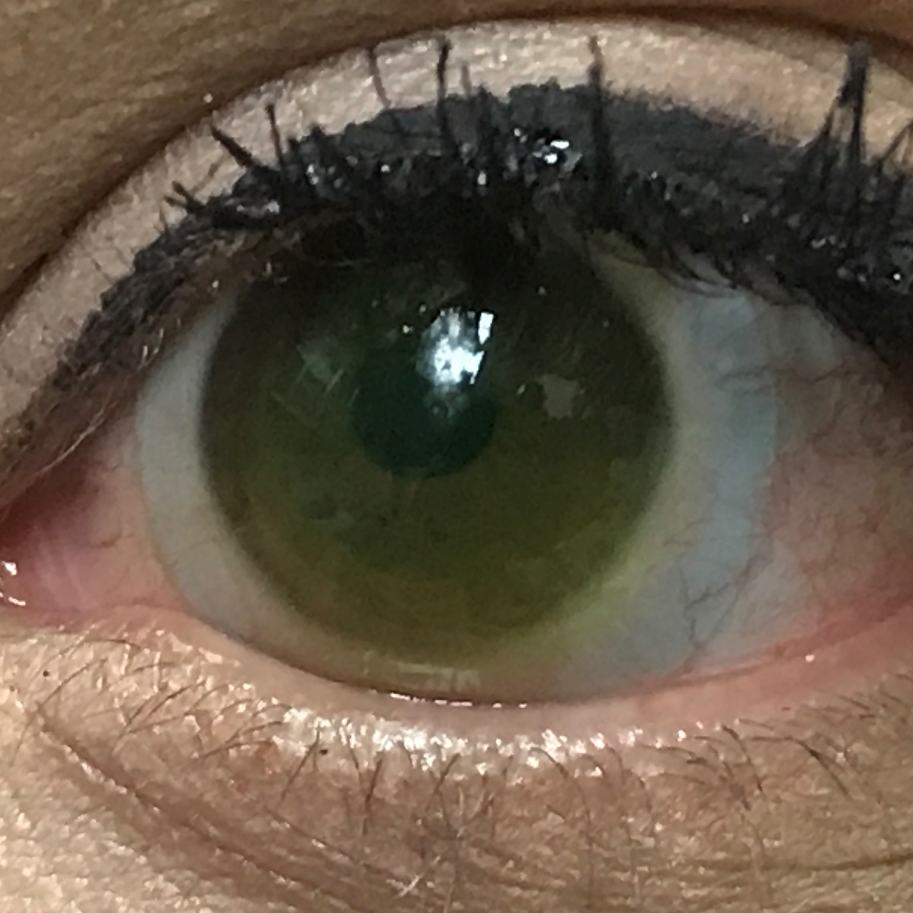 
                  Sceral lens on an eye with advanced keratoconus