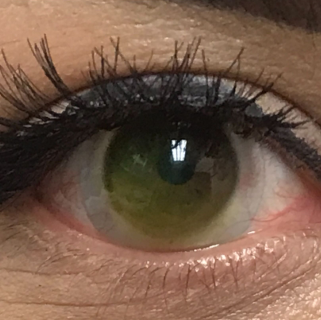 
                  Sceral lens on an eye with advanced keratoconus