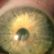 Corneal Transplant