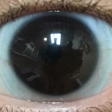 
                  Sceral lens on an eye with moderate keratoconus