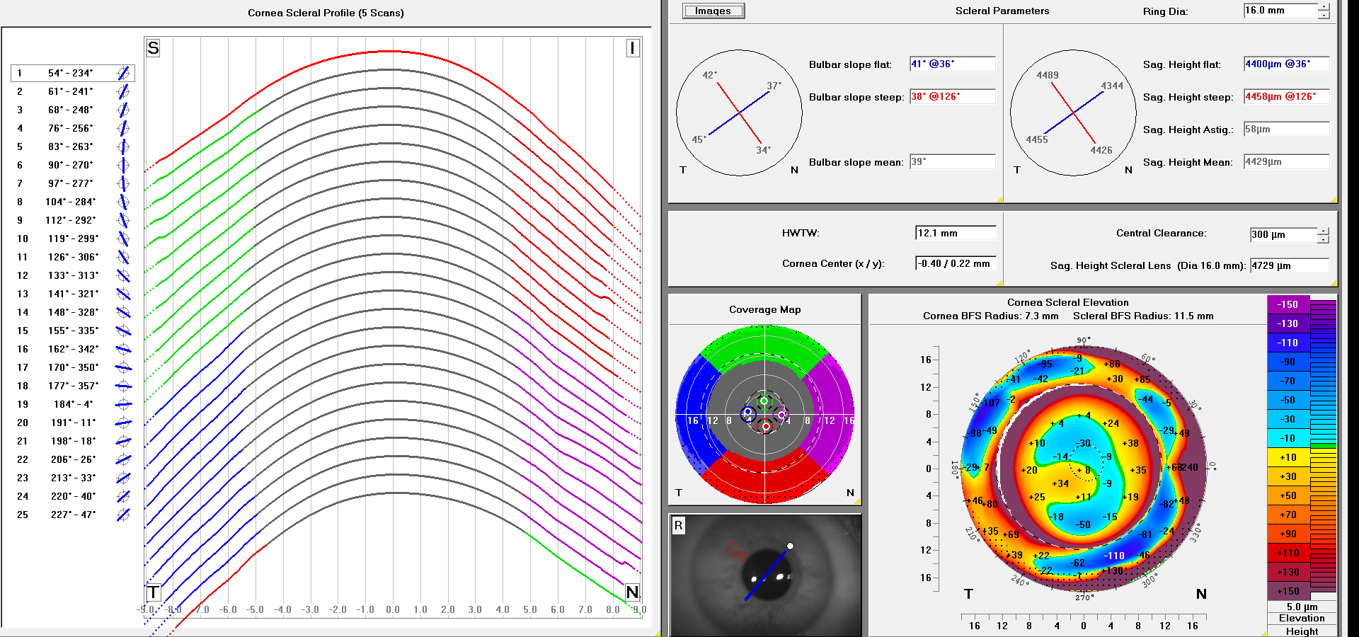 Scleral lens design