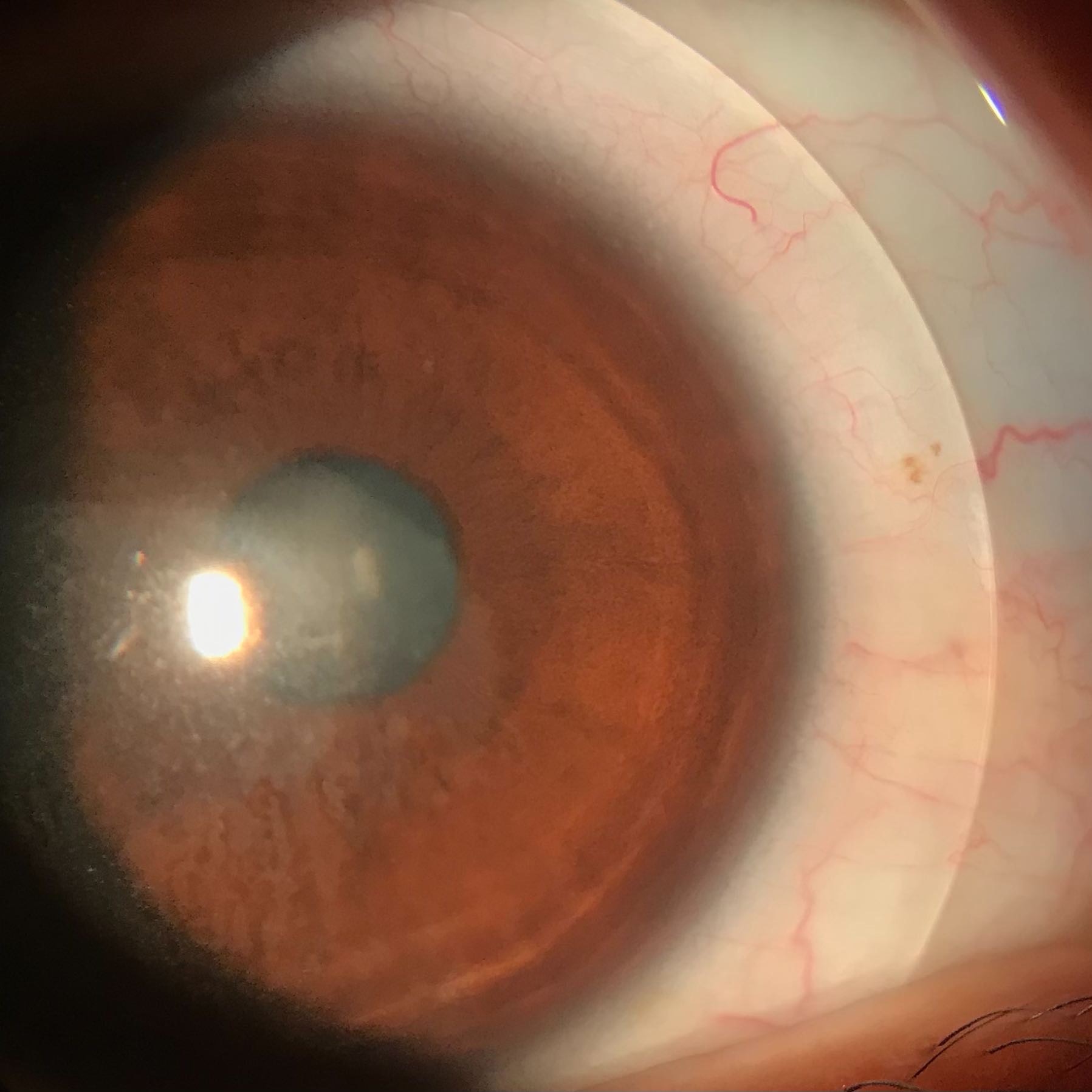 Scleral lens